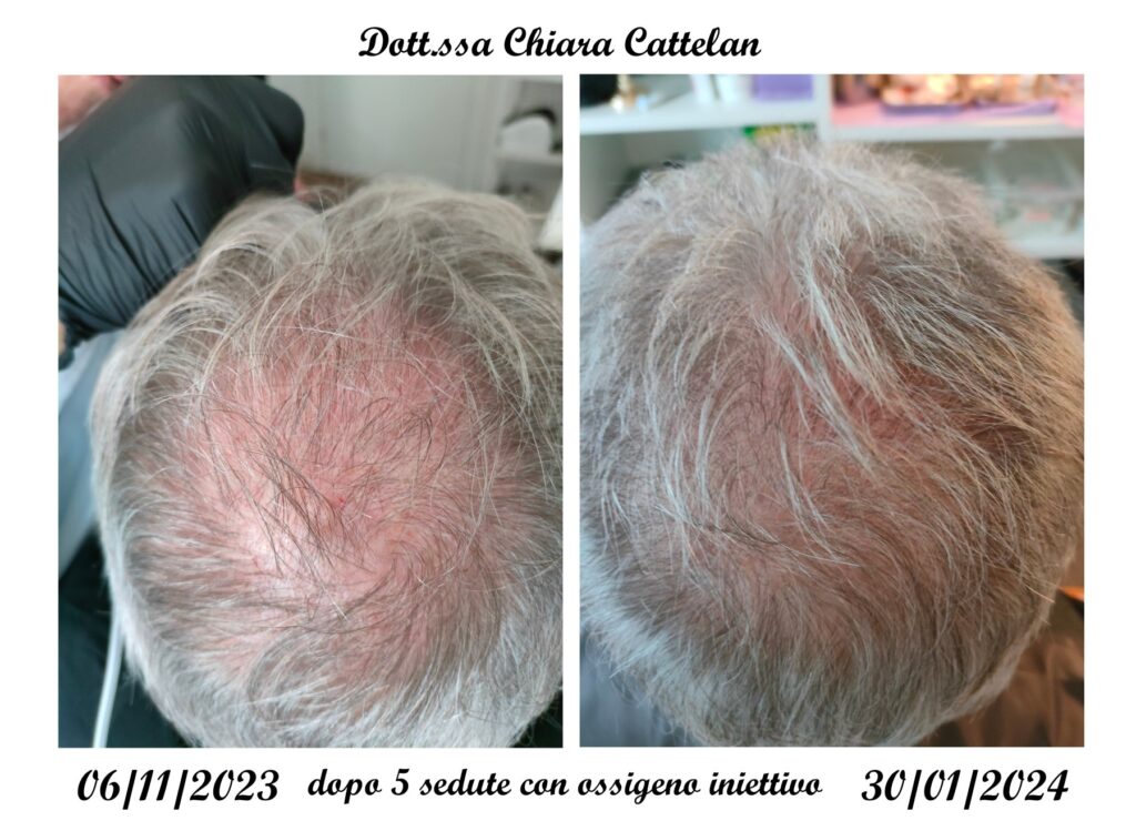Perdita dei capelli